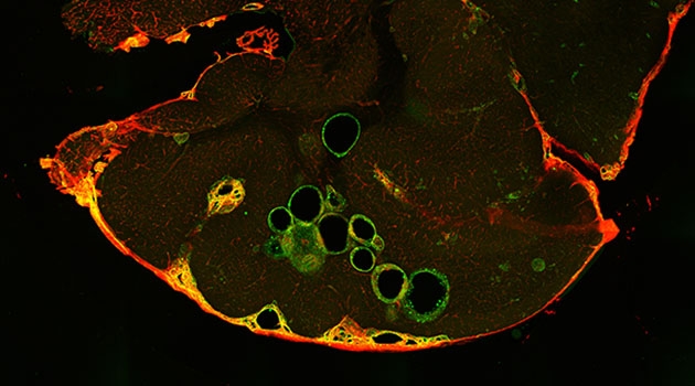 Behandling med propranolol minskar antalet och storleken på kavernom. Bilden visar ett snitt av hjärna från en mus som behandlats med propranolol. Kärlmissbildningarna, kavernom, visas i grönt.